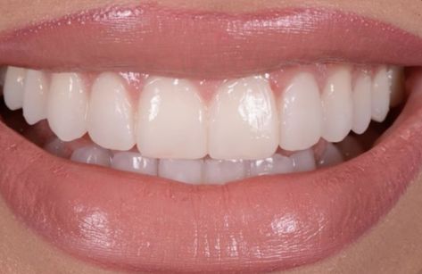 Pretty Teeth Aesthetic, Teeth Claims For Dr, Perfect Smile Aesthetic, Pretty Smile Aesthetic, Dream Teeth, Teeth Aesthetic, Pretty Teeth, Veneers Teeth, Beautiful Teeth