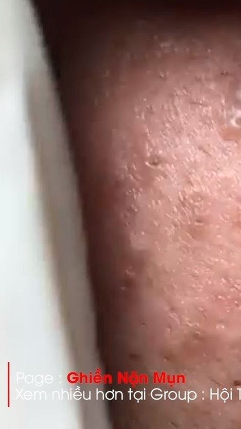 Instagram post by Pimple Popper Videos • Sep 10, 2020 at 8:00am UTC Pimple Removal Video, Pimple Extraction Videos, Pimple Poppìng Videos Satisfying, Overnight Pimple Remedies, Hard Pimple, Popping Pimples Videos Youtube, Lip Pimple, Zit Remedy, Head Pimples