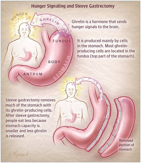 Stomach Sleeve, Fibroid Surgery, Gastric Problem, Sleeve Gastrectomy, Gastrointestinal System, Sleeve Surgery, Surgical Procedures, Laparoscopic Surgery, General Surgery