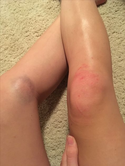 Knee Injury Prank, Back Injury Snapchat, Leg Injured Images, Injured Leg Snap, Leg Wound Fake Story, Injury In Leg, Fracture Leg Snapchat, Leg Accident Real Pic, Scraped Knees Aesthetic