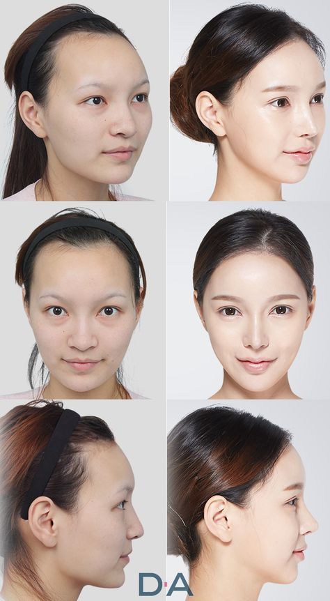 Korean Surgery, Kpop Plastic Surgery, Face Symmetry, Nose Plastic Surgery, V Line Surgery, Fenugreek For Hair, Plastic Surgery Korea, Plastic Surgery Fail, Korean Plastic Surgery