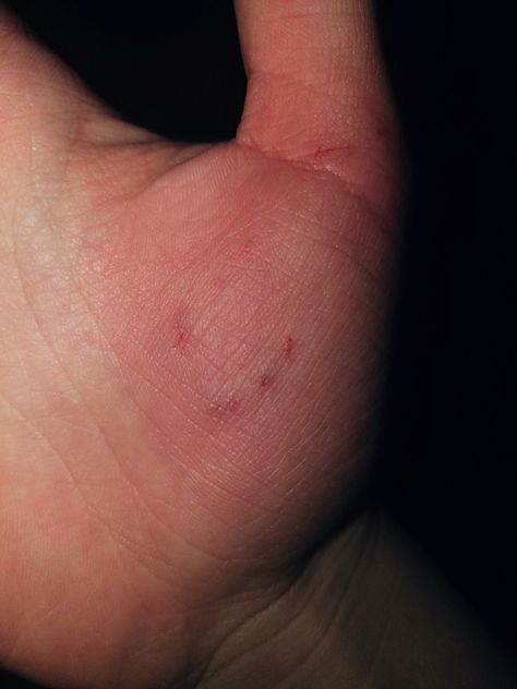 Tangan Di Gores Kaca, Hand Bleeds Snap, Hand Scratch Fake Story, Hand Hurt Fake Story, Leg Wound Fake Story, Laslas Prank, Prank Jatuh, Hand Kata Pic Bled, Injury Fake Story