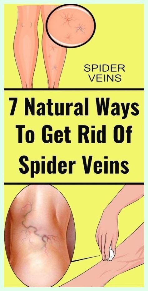 Home Remedies For Spiders, Get Rid Of Spiders, Varicose Vein Remedy, School Communication, Creating A Newsletter, Abdominal Exercises, Natural Healing, Holistic Health, Back Pain