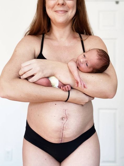 A MUM who had 40 staples in her stomach after an emergency C-section birth has proudly shared pictures of her unusual vertical scar on social media. Erin Bahadur, 36, from North Carolina, gave birth to her second child, daughter Remy, in December 2020. The mum suffered from a complete placenta previa – when the baby’s […] C Section Scar, Wedding Bodysuit, C Section Scars, Emergency C Section, Cesarean Section, First Person Writing, C Section, Fresh Face, Second Child