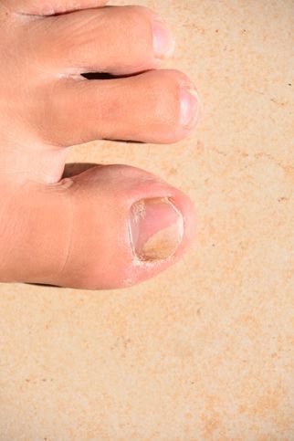 Staying one step ahead of toenail fungus - Harvard Health Toenail Fungal Infection, Natural Antifungal, Nail Infection, Nail Fungus Remedy, Fungal Nail, Tongue Health, Nails Today, Ingrown Toe Nail, Striped Nails