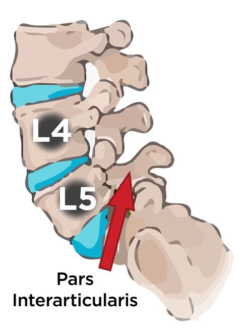 What is a pars defect? Your pars interarticularis is a bony bridge-like structure that is placed in between two joints in your vertebrae. An injury to this bone is referred to as a pars defect, which refers to a break in that location. This typically occurs in your lower or lumbar region of your back and can result in spondylolisthesis and spondylolysis. | BraceAbility Spine Problems, Lumbar Pain, Severe Back Pain, Middle Back Pain, Lower Back Pain Exercises, Back Pain Remedies, Nerve Pain Relief, Back Pain Exercises, Hip Pain