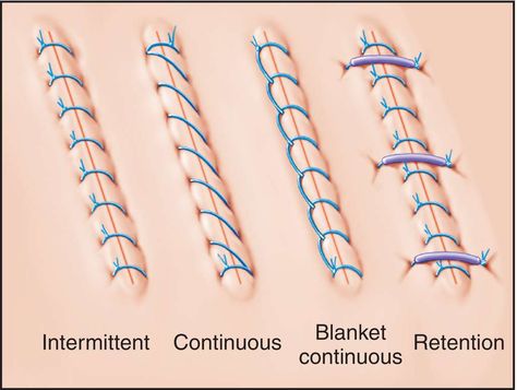 http://medical-dictionary.thefreedictionary.com/_/viewer.aspx?path=MosbyMD types of stiches Vet Tech Tattoo, Stitches Medical, Surgical Technologist Student, Tech Tattoo, Surgical Technician, Surgical Suture, Medical Dictionary, Surgical Technologist, Vet Medicine