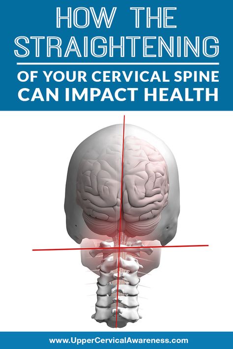 What causes straight neck? How do some people end up with a reverse curve in the neck? How can these conditions impact not only spine pain but also overall health? We will address these questions and direct you to a natural solution. #NeckPainRelief #NeckAcheRelief #NaturalRelief Cervical Spine Exercises, Upper Cervical Chiropractic, Cervical Spondylosis, Spine Pain, Middle Back Pain, Neck Injury, Neck Exercises, Back Pain Remedies, Cervical Spine