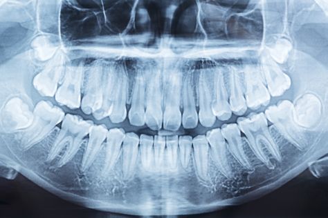 The American Academy of Oral and Maxillofacial Radiology (AAOMR) no longer recommends reproductive organs and fetuses be covered during dental imaging. Dry Socket Symptoms, Wisdom Teeth Extraction, Wisdom Teeth Swelling, Teeth Extraction, After Wisdom Teeth Removal, Jaw Exercises, Impacted Tooth, Wisdom Tooth Extraction, Wisdom Teeth Removal