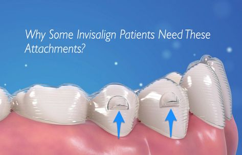 Find Out Why Some Invisalign Users Need Attachments Cleaning Invisalign Trays, Invisalign Tips And Tricks, Invisalign Before And After, Invisalign Aesthetic, Before And After Invisalign, Invisalign Attachments, Invisalign Hacks, Permanent Retainer, Loose Teeth