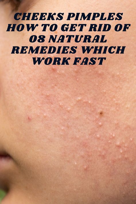 Cheeks Pimples How To Get Rid Of 08 Natural Remedies Which Work Fast #acne #pimples #pimplesremedies #acneremedies #skincarediy. https://whispers-in-the-wind.com/combatting-pimples-under-the-skin-expert-tips-and-product-recommendations/?46 How To Get Rid Of Papules, How To Get Rid Of Bumps On Cheeks, How To Get Rid Of Small Pimples On Face, Small Pimples On Face Remedies, Small Pimples On Face, How To Get Rid Of Pimples Fast, Cheek Pimples, Hard Pimple, Pimple Remedies