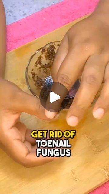 Fingernail Fungus Remedies, Toe Nail Fungus Home Remedy, Thick Toenail Remedy How To Get Rid, How To Get Rid Of Fungal Toenails, Toenail Health, Toenail Removal, Black Toe Nails, Nail Remedies, Upper Lip Hair