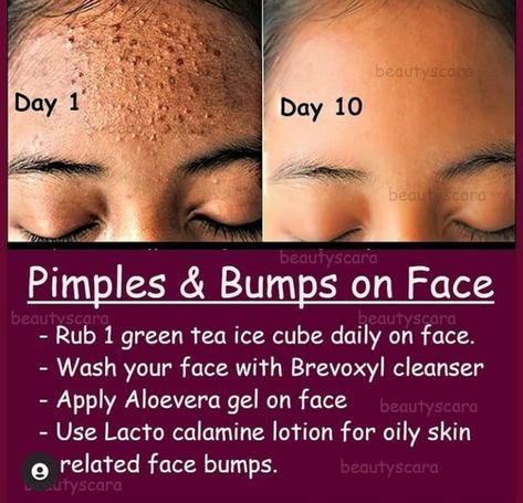 Small Pimples On Face, Bumps On Face, Small Bumps On Face, Beginner Skin Care Routine, Blind Pimple, Pimples Under The Skin, Lotion For Oily Skin, Pimples On Face, Pimples Remedies