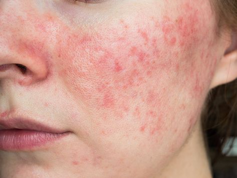 Everything You Need To Know About Rosacea | Chatelaine Acne Skincare Routine, Skin Clinic, Remove Acne, Holistic Healing, Skin Care Acne, Dermatology, Skin Problems, Skin Conditions, Acne Prone Skin