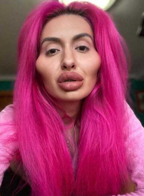 Extreme Plastic Surgery, Plastic Surgery Fail, Plastic Surgery Gone Wrong, Botox Lips, Bad Fashion, Celebrity Plastic Surgery, Celebrities Then And Now, Under The Knife, Cosmetic Procedures