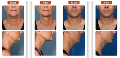 Non Surgical Facelift, Anti Aging Beauty, Peeling Skin, Skin Secrets, Anti Wrinkle Cream, After Pictures, Chemical Peel, Glowy Skin, Skin Care Remedies