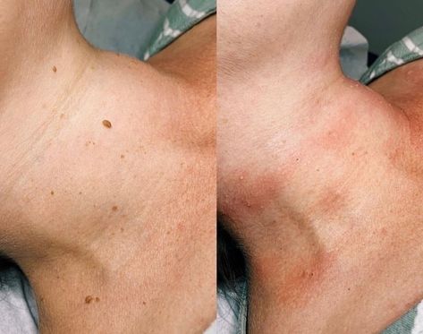 Are you tired of dealing with unsightly blemishes on your skin? With the right help, you can have moles, warts, verrucas, and skin tags removed quickly and efficiently. Visit our website today to learn more about how to get started! #moleremoval #wartremoval #verrucaremoval #skintagremoval #SafetyFirst #skinexpert Verruca Removal, Mole Meaning, Warts Removal, Skin Tags On Face, Red Moles, Mole Removal, Skin Tags, Blood Sugar Diet, Coconut Health Benefits