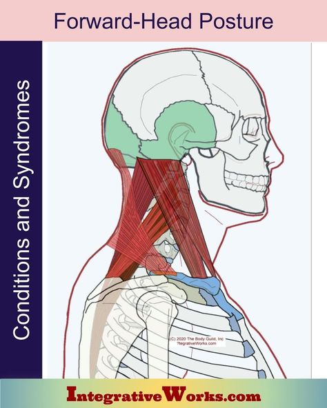 Cervicogenic Headache, Tmj Relief, Thoracic Outlet, Forward Head Posture Exercises, Neck Hurts, Neck And Shoulder Muscles, Therapy Techniques, Forward Head Posture, Neck Problems