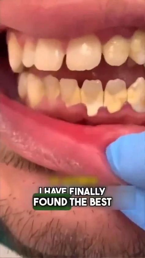 Natural Teeth Whitening Diy, Home Teeth Whitening, Banana Peels, Teeth Whitening Homemade, Whitening Teeth, Face Skin Care Routine, Teeth Whitening Diy, Whiten Your Teeth, Diy Skin Care Routine