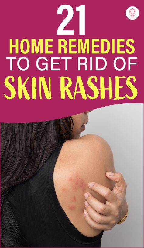 21 Home Remedies To Get Rid Of Skin Rashes: We have all had rashes at some point in our lives. They not only cause itching and pain but also put you through a lot of discomfort. While a few go away on their own, others take time. Skin rashes could also be a result of a more serious underlying skin condition – another reason to steer clear of them. Are there any natural remedies for rashes? Keep reading to find out. #skincare #skincaretips #skinrashes #remedies #homeremedies Itching Skin Remedies, Natural Rash Remedies, Essential Oils For Rash, Skin Rash On Face, Face Rash Remedies, Skin Rash Remedies, Home Remedies For Rashes, Types Of Skin Rashes, Body Rash