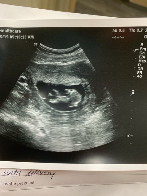 1st ultrasound of baby girl! Ultrasound Pictures 2023, 3 Month Ultrasound Pictures, Ultrasound Pictures 1 Month, 2 Month Ultrasound Picture, Fake Ultrasound Pictures 4 Weeks, Fake Ultrasound Pictures 2023, First Ultrasound Picture Ideas, 3 Month Ultrasound, Fake Ultrasound Pictures