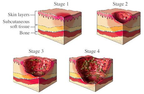 Mrsa Skin Infection in animals | Bed Sores - prevention and care Wound Care Nursing, Bed Sores, Pressure Ulcer, Nursing Tips, Wound Care, Holistic Nutrition, Natural Home Remedies, Natural Gifts, Natural Treatments