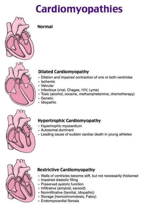 Cardiomyopathy Types Mnemonics Cheat Sheets for Nursing Students. #Nursing #Cardiomyopathies dilated cardiomyopathy causes mnemonic.  Dilated Hearts End In Terrible Infiltration. Cardiology Nursing, Medical Assistant Student, Nursing Cheat, Nursing School Essential, Nurse Study Notes, Nursing Mnemonics, Nursing Student Tips, Medical Student Study, Cardiac Nursing