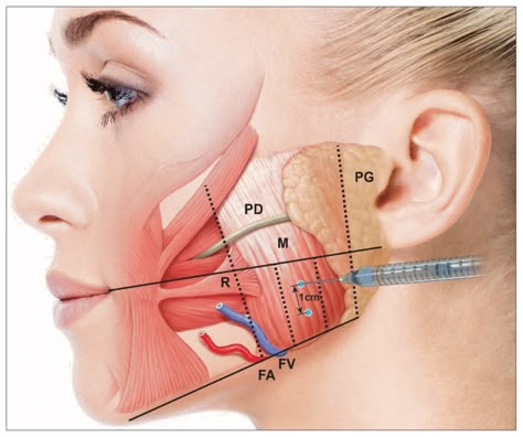 How Botox can be used for Face Slimming - Boss Gal Beauty Bar Face Injections, Botox Injection Sites, Botox Training, Facial Injections, Botox Before And After, Aesthetic Dermatology, Botox Face, Facial Fillers, Cosmetic Injectables