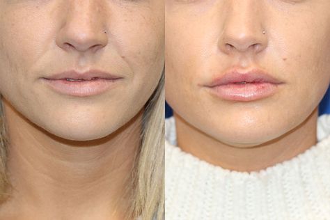 Lip Augmentation Before And After, Lipfiller Before After, Lip Fillers Before And After, Lip Injections Before And After, Lip Fillers Before And After 1ml, 0.5 Ml Lip Filler Before And After, Lip Filler Before And After, Lip Implants, Beauty Enhancement