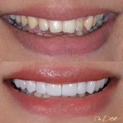 Our results gallery shows before and after images for treatments such as porcelain veneers, Invisalign Lite, Invisalign Full, teeth whitening, and gum laser surgery, Composite Veneers, Clear Braces, Dental Design, Laser Surgery, Straight Teeth, Porcelain Veneers, Dental Center, General Dentistry, Smile Design