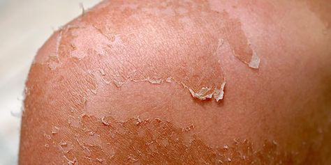 Skin Peeling: How to stop it and protect yourself from sunburns Burns On Skin, Severe Sunburn, How To Treat Sunburn, Sunburn Peeling, Bad Sunburn, Sunburn Remedies, Sunburn Skin, Aloe Vera Benefits, Natural Face Care