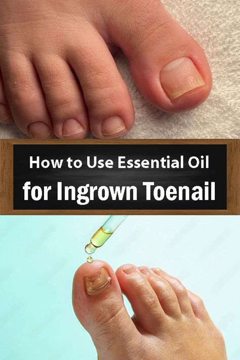 How to Use Essential Oils for Ingrown Toenail How To Get Rid Of Ingrown Toenails, Diy Ingrown Toenail Remedy, How To Treat Ingrown Toenail, Remove Ingrown Toenail, Ingrown Toenail Remedy, Ingrown Toenail Remedies, Toenail Pain, Infected Toenail, Toenail Health