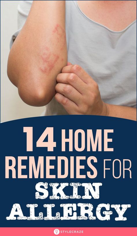 Skin Rash Remedies, Home Remedies For Rashes, Allergy Rash, Rashes Remedies, Natural Antihistamine, Home Remedies For Allergies, Remedies For Skin, Natural Remedies For Allergies, Skin Allergy