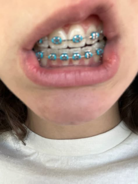 Teal Braces Aesthetic, Aqua Braces, Mint Green Braces, Turquoise Braces, Teal Braces, Brackets Aesthetic, Light Blue Braces, Braces Aesthetic, Braces Colors Combinations