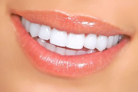 Natural Teeth Whitening Diy, Snap On Smile, Kedokteran Gigi, Veneers Teeth, Teeth Whitening Remedies, Beautiful Teeth, Teeth Whitening Diy, Laser Teeth Whitening, Straight Teeth