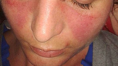 The Skin Rash On Face, Skin Rashes Pictures, Types Of Skin Rashes, Common Skin Rashes, Rash On Face, Skin Rashes, Oily Skin Acne, Home Remedies For Skin, Dry Skin Patches