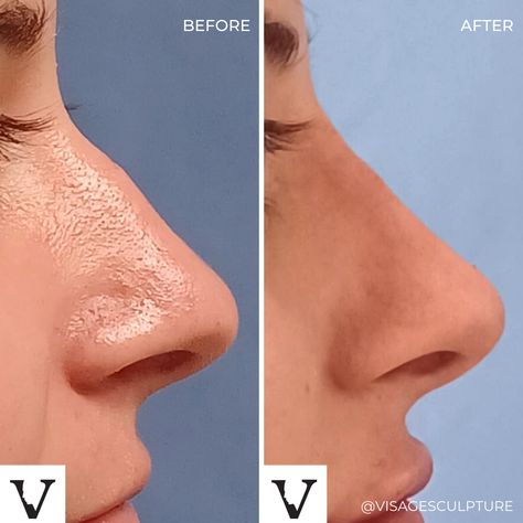 Nose Filler, Nose Fillers, Rhinoplasty Nose Jobs, Non Surgical Facelift, Injectables Fillers, Nose Job, Before And After Pictures, Not Ready, Skin Tightening