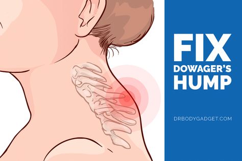 Learn what causes some people to develop a hump on their neck and how to fix it using the best dowager's hump exercises. READ MORE. Exercises To Fix Neck Hump, Fix Hump On Neck, Hump On Neck, Neck Hump Exercises For Women, Dowagers Neck Exercises, How To Fix Neck Hump, Hump On Back Of Neck, Fix Neck Hump, Dowagers Hump