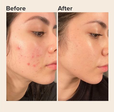 Acne Solutions, Skin Care Solutions, روتين العناية بالبشرة, Acne Skin, Skin Care Treatments, Glass Skin, Skin Rejuvenation, Skin Treatments, Retinol