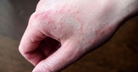 Eczema giving you hell? Experts offer advice on how to ease pain caused by common skin condition - Mirror Online http://www.mirror.co.uk/lifestyle/health/eczema-giving-you-hell-experts-11263362 Heat Rash Remedy, Rash On Hands, Rashes Remedies, Heat Rash, Workout Chart, Body Treatments, Sensitive Skin, Salt, Skin