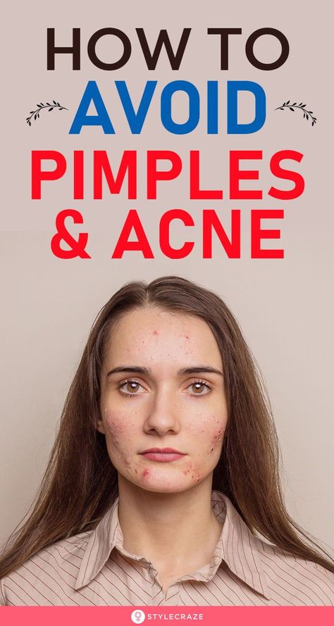 How To Avoid Pimples And Acne: You need a systematic approach involving self-care, lifestyle and diet changes, and a thorough skin care routine to prevent and get rid of pimples. In this article, we have discussed the causes of pimples and tips and remedies to prevent them. #Beauty #BeautyTips #Acne #Pimples How To Avoid Pimples, Causes Of Pimples, Pimple Causes, Blind Pimple, Get Rid Of Pimples, Rid Of Pimples, Diet Changes, Pimples Under The Skin, How To Reduce Pimples