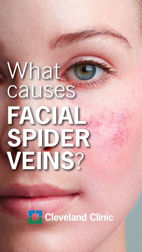 What causes spider veins on your face + how to treat it.  #skincare #skinhealth #dermatology #health Veins On Face, Spider Vein Remedies, Blood Vessels On Face, Facial Veins, Get Rid Of Spiders, Vein Removal, Under Eye Makeup, Unwanted Hair Removal, The Spider