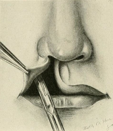 Image from page 543 of "The practice of surgery" (1910) | Flickr Maxillofacial Surgery Wallpaper, Surgery Art, Columbia University Library, The Surgeon, Nose Surgery, Reconstructive Surgery, Eye Surgery, Columbia University, Plastic Surgery