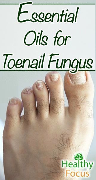 athletes foot remedy nail fungus Skin Tags Essential Oils, Toenail Fungus Essential Oils, Oregano Oil Benefits, Health Coconut Oil, Esential Oils, Toenail Fungus Remedies, Oregano Essential Oil, Essential Oil Remedy, Oregano Oil