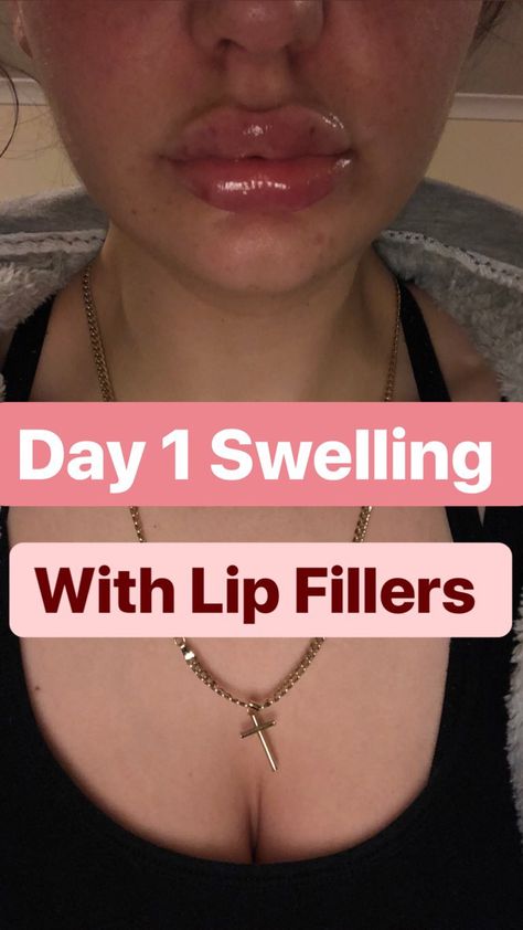 Lip filler swelling Lip Filler Swelling, Lip Filler, Lip Fillers, Cross Necklace, Lips