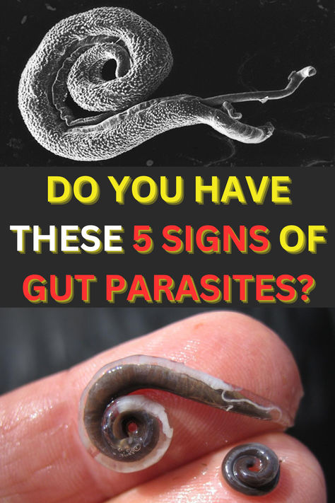 Did you know that signs of intestinal parasites may include: 1. Abdominal discomfort. 2. Diarrhea. 3. Nausea 4. Gas or bloating. 5. Rash or itching #parasite #parasitecleanse Heal Leaky Gut, Intestinal Parasites, Health Smoothie Recipes, Gut Health Diet, Candida Overgrowth, Parasite Cleanse, Probiotic Benefits, Abdominal Discomfort, Gut Health Recipes