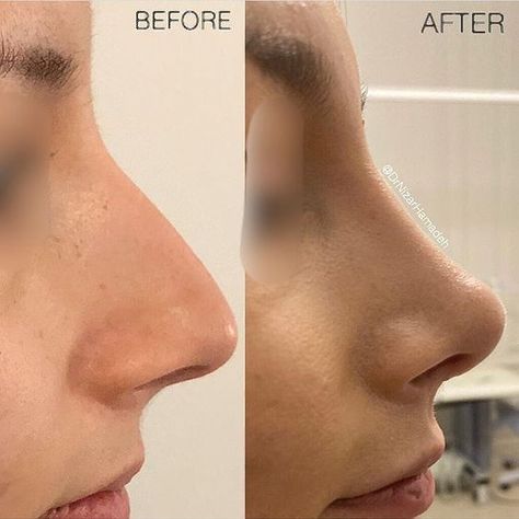 Before and after - Rhinoplasty by Dr. Nizar Hamadeh (UK). Changes made to both the bridge and tip of nose. Noise Job, Nose Plastic Surgery, Nose Surgery Rhinoplasty, Body Contouring Surgery, Rhinoplasty Nose Jobs, Rhinoplasty Before And After, Face Surgery, Pretty Nose, Beauty Procedures