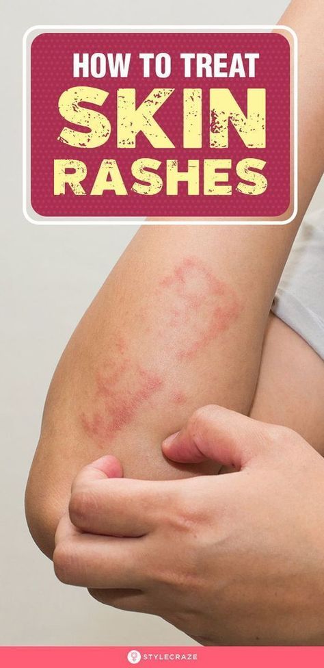 12 Natural Remedies to Reduce Eczema Symptoms Skin Rash Remedies, Home Remedies For Rashes, Common Skin Rashes, Itchy Skin Rash, Body Rash, Rash On Face, Rashes Remedies, Itchy Rash, Home Remedies For Skin