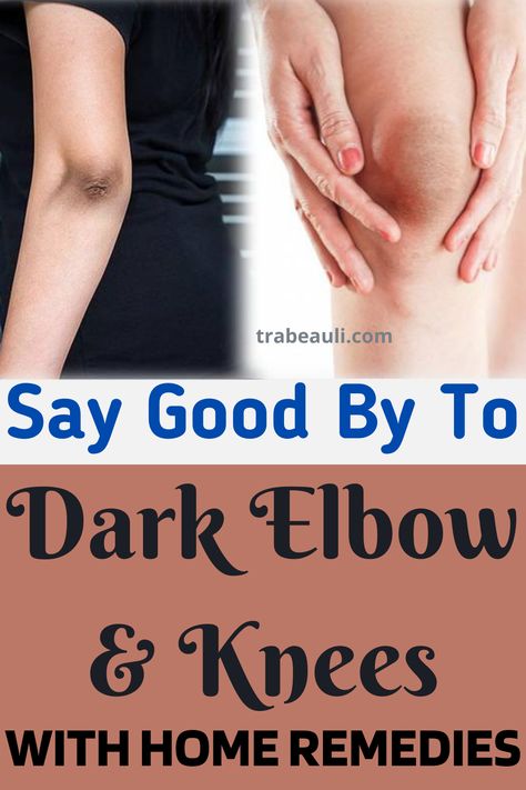 Some amazing home remedies for black elbow and knees to get rid of dark elbows overnight. These remedies daily or even alternate days use and you will find a great change in your knee and elbow skin. Check out the blog- #darkknees #darkelbows #homeremedies #elbowandknees #removeblackelbow How To Lighten Knees, Sagging Cheeks, Dry Elbows, Dark Elbows, Dark Underarms, Dark Spots On Skin, Saggy Skin, Dewy Skin, Natural Remedy