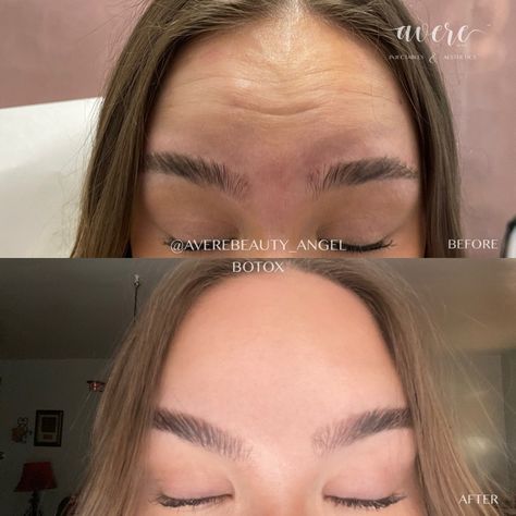 Botox before and after in forehead Botox In Forehead Before And After, Forehead Botox Before And After, Botox Before After, Forehead Lift, Botox Before And After, Botox Fillers, Cosmetic Surgery, Aesthetic Makeup, Smooth Skin